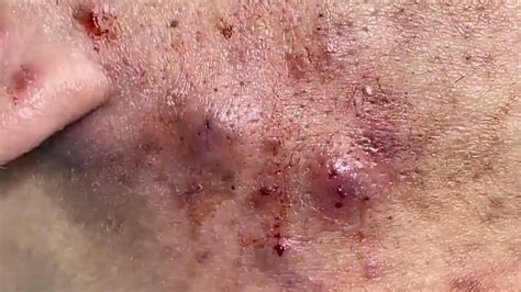 acné youtube|cystic acne inflamed worst videos.